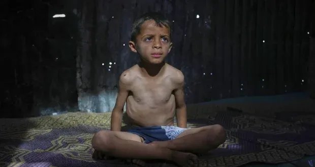 غزة: أطفال على شفير الموت جوعاً في ظل حصار خانق وتدهور كارثي للتغذية