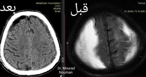 جراحة دماغ واعي تنقذ حياة مريض في طرطوس لم يحتمل التخدير العام