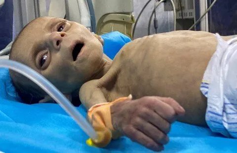 جراح بريطاني من غزة: الاحتلال يُسلّح شعبًا بالتجويع وأطفال يموتون جوعًا