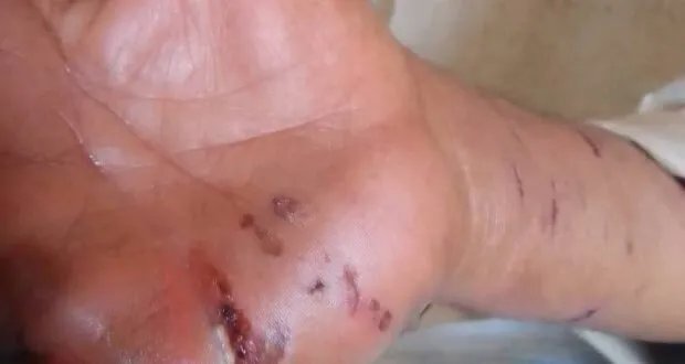 تزايد حالات العض والشكاوى من الكلاب الشاردة في درعا: 116 مراجعاً لقسم داء الكلب