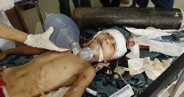 غزة تحت وطأة المجاعة: ارتفاع الوفيات إلى 212 شهيدًا بسبب سوء التغذية والحرب الإسرائيلية