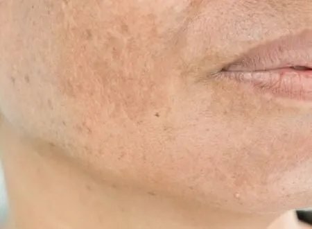 تخلصي من تصبغات الوجه: دليل شامل لبشرة مشرقة وموحدة اللون