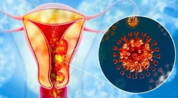 الكشف المبكر ينقذ الأرواح: قصص نجاح في مواجهة سرطان الرحم