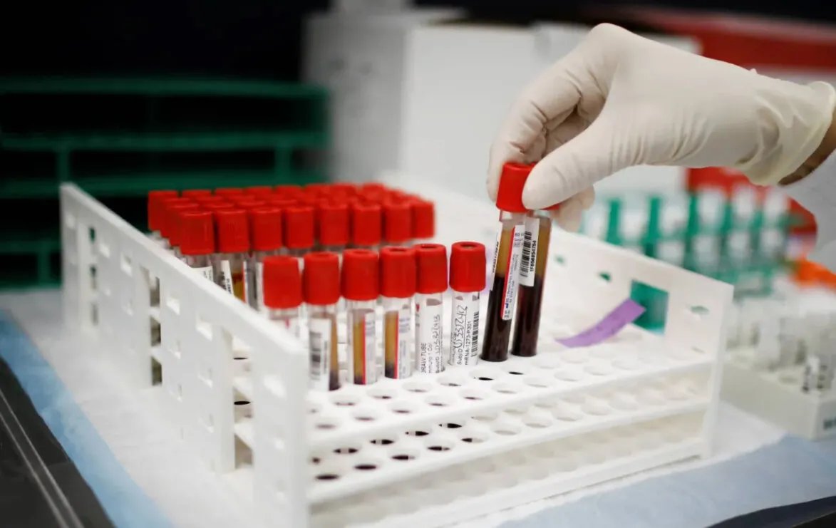 طفرة في تشخيص أمراض الكلى: اختبار جديد يتفوق على الكرياتينين في تحديد المضاعفات