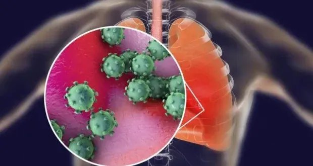 تحذيرات من متحور "نيمبوس" الجديد: الأعراض وطرق العلاج