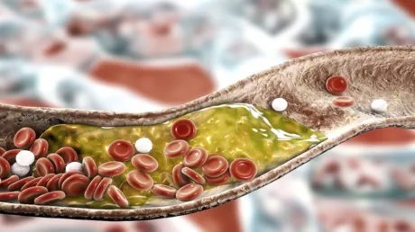 طفرة في علاج الكوليسترول: جرعة واحدة من دواء VERVE-102 قد تكفي مدى الحياة