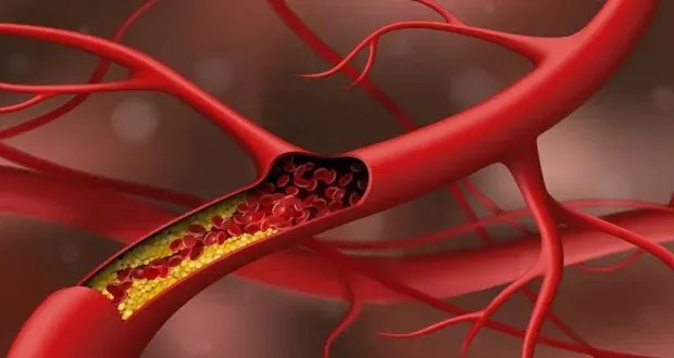 طفرة في علاج الكوليسترول: هل نتخلص نهائياً من خطر أمراض القلب؟